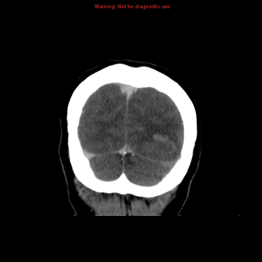 Cerebral venous infarction (Radiopaedia 12404-20735 B 74).jpg