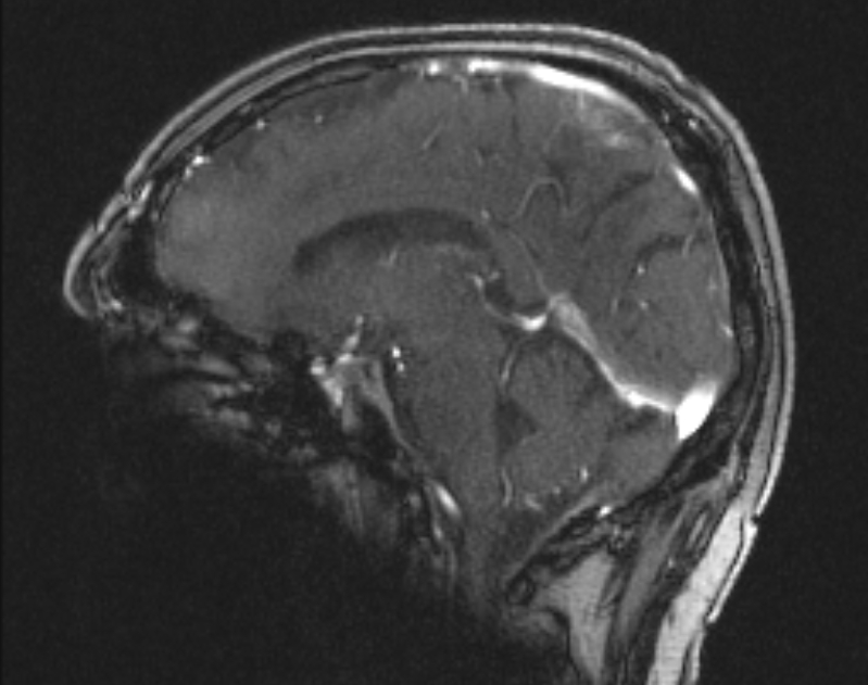 Cerebral venous infarction (Radiopaedia 65166-74176 Sagittal TOF 35).jpg