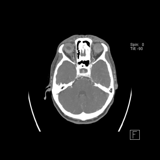 Cerebral venous infarction with hemorrhage (Radiopaedia 65343-74396 A 32).jpg