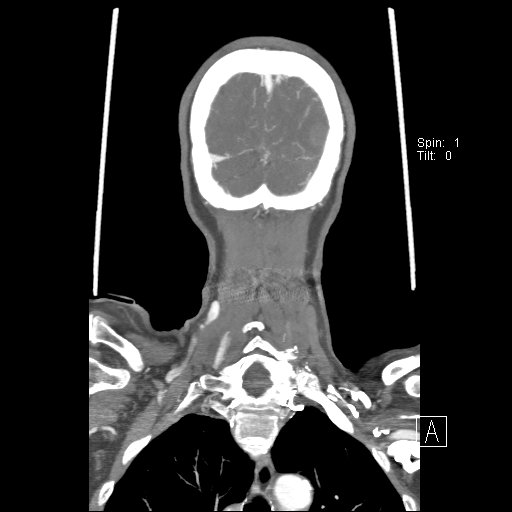 Cerebral venous infarction with hemorrhage (Radiopaedia 65343-74396 B 240).jpg