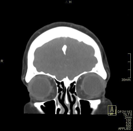 Cerebral venous sinus thrombosis (Radiopaedia 91329-108965 Coronal venogram 14).jpg