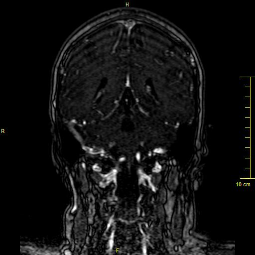 Cerebral venous thrombosis (Radiopaedia 23288-23351 MRV 108).JPG
