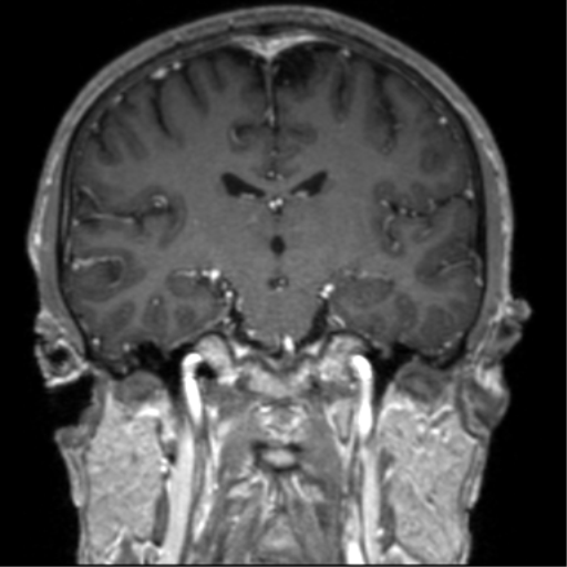 Cerebral venous thrombosis (Radiopaedia 38392-40469 Coronal T1 C+ 43).png