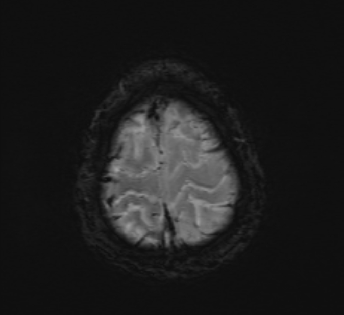 Cerebral venous thrombosis (Radiopaedia 71207-81504 Axial SWI 49).jpg