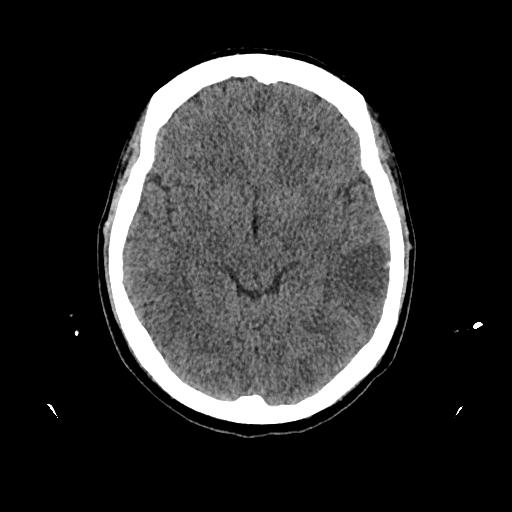 Cerebral venous thrombosis with venous hemorrhagic infarct (Radiopaedia 90354-107660 Axial non-contrast 23).jpg
