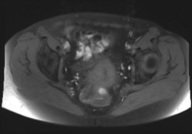 File:Cervical carcinoma (Radiopaedia 88312-104943 Axial T1 fat sat 13).jpg