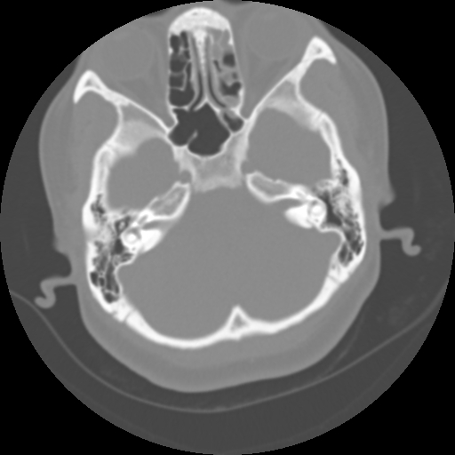 Cervical rib (Radiopaedia 71110-81363 Axial non-contrast 7).jpg