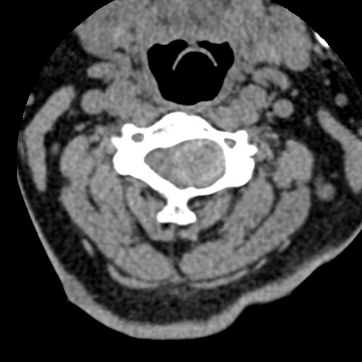 File:Cervical spinal neurofibroma in a patient with NF1 (Radiopaedia 58344-65464 Axial non-contrast 31).jpg