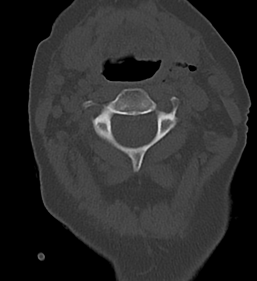 Cervical spine ACDF loosening (Radiopaedia 48998-54070 Axial bone window 20).png
