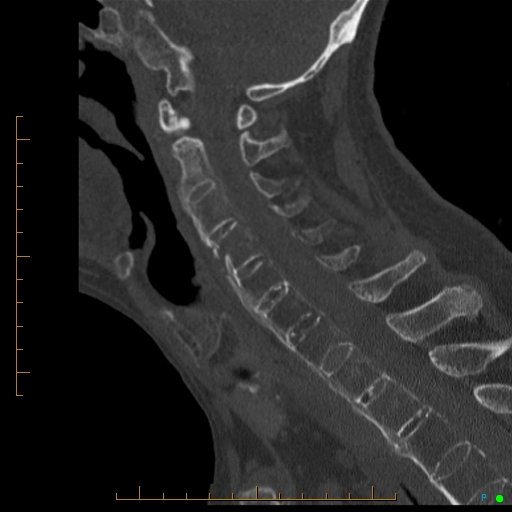 File:Cervical spine fracture - ankylosing spondylitis (Radiopaedia 76835-88706 Sagittal bone window 53).jpg