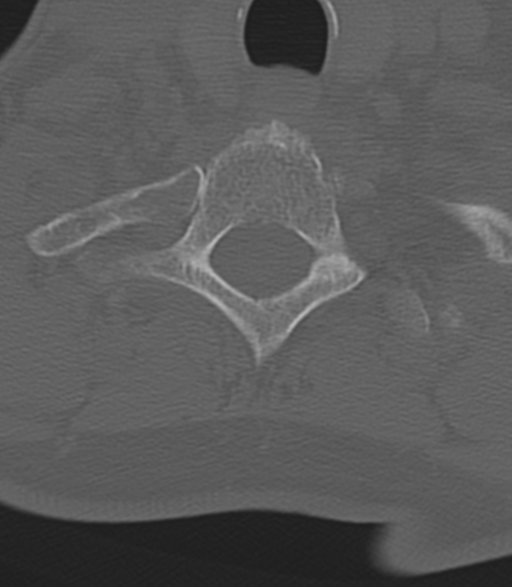 Cervical spine fractures with vertebral artery dissection (Radiopaedia 53296-59268 Axial bone window 48).png
