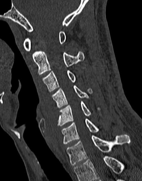 File:Cervical spondylodiscitis (Radiopaedia 28057-29489 Sagittal bone window 31).jpg