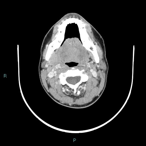 File:Cervical thymic cyst (Radiopaedia 88632-105335 C 80).jpg