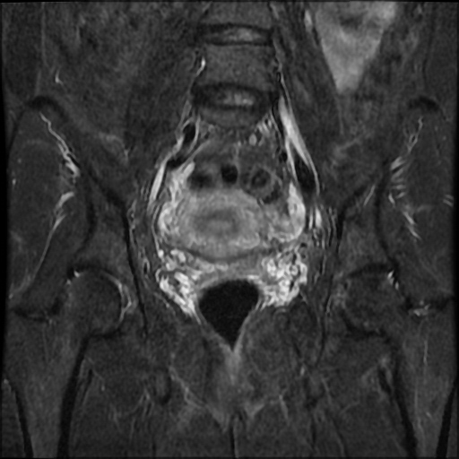 File:Cesarian section scar endometriosis (Radiopaedia 66520-75799 Coronal STIR 19).jpg