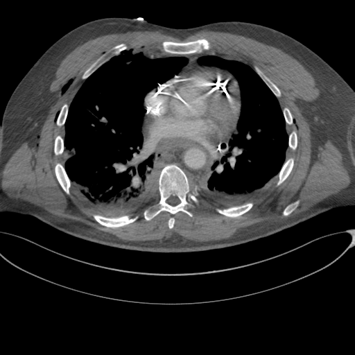 File:Chest multitrauma - aortic injury (Radiopaedia 34708-36147 A 168).png
