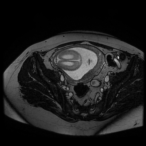 Chiari II malformation - fetal MRI (Radiopaedia 68099-77581 Axial Fiesta 45).jpg