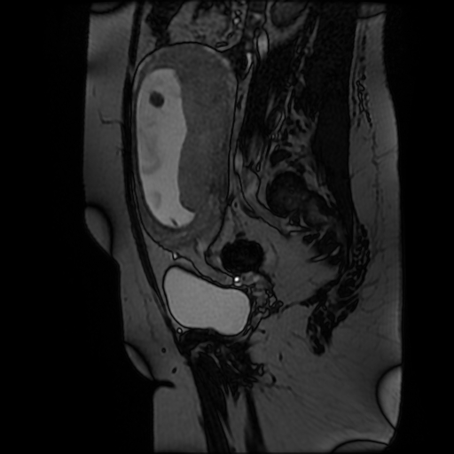 Chiari II malformation - fetal MRI (Radiopaedia 68099-77581 Sagittal Fiesta 37).jpg