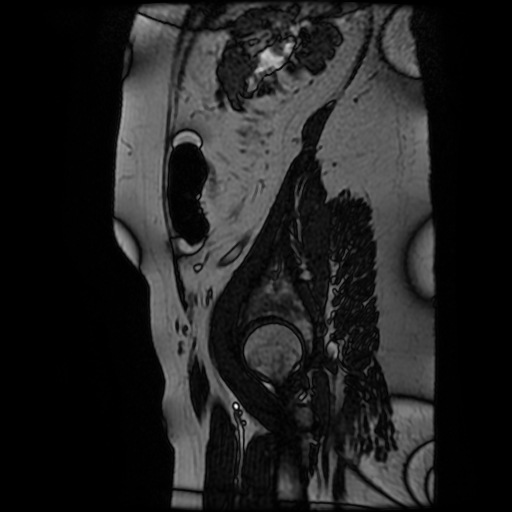 File:Chiari II malformation - fetal MRI (Radiopaedia 68099-77581 Sagittal Fiesta 51).jpg