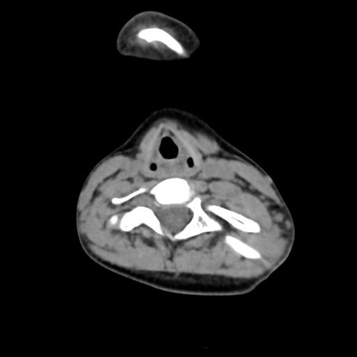 Chiari I with syrinx and skull base anomalies (Radiopaedia 89444-106412 Axial non-contrast 101).jpg