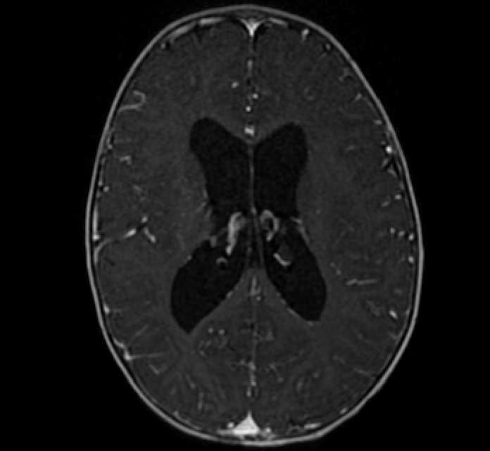 Chiasmatic-hypothalamic glioma (Radiopaedia 90079-107252 Axial T1 C+ 54).jpg