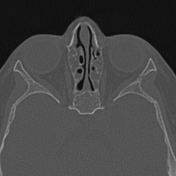 Choanal atresia (Radiopaedia 88525-105975 Axial bone window 74).jpg