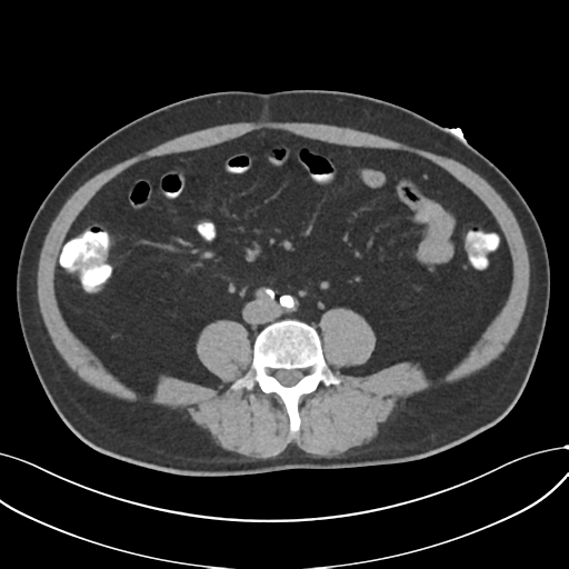File:Cholecystitis with focal perforation and hepatic abscess (Radiopaedia 37189-38945 Axial non-contrast 51).png