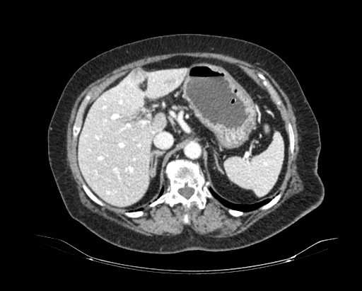 Cholecystoduodenal fistula (Radiopaedia 48959-54022 A 116).jpg