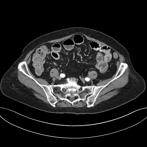 Cholecystoduodenal fistula due to calculous cholecystitis with gallstone migration (Radiopaedia 86875-103077 A 51).jpg