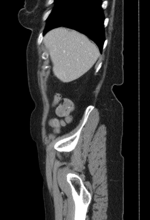 Cholecystoduodenal fistula due to calculous cholecystitis with gallstone migration (Radiopaedia 86875-103077 F 52).jpg