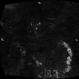 Choledochal cyst - type Ia (Radiopaedia 85673-101454 F 5).jpg