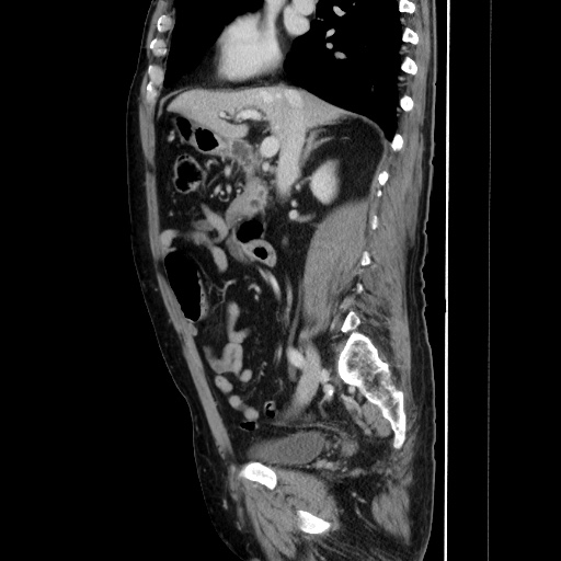 Choledocholiathiasis with normal caliber common bile duct (Radiopaedia 75368-86632 D 70).jpg