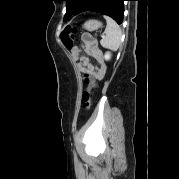 Choledocholithiasis on CT and MRI (Radiopaedia 24825-25087 D 51).jpg