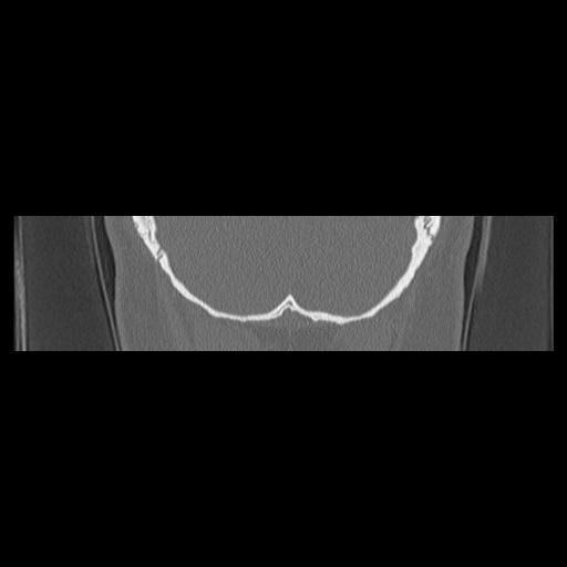 Cholesteatoma (Radiopaedia 84946-100455 Coronal bone window 145).jpg