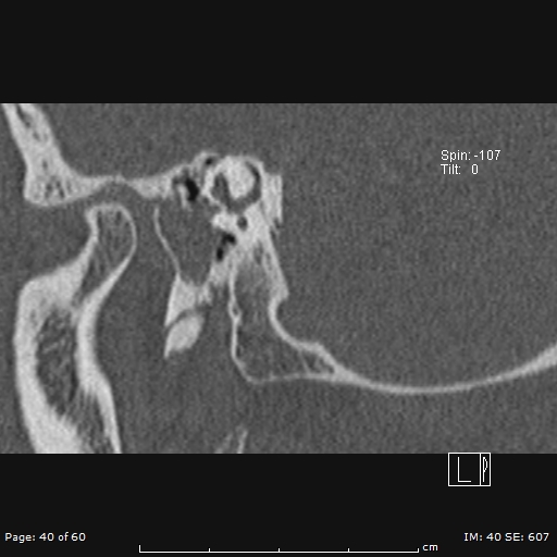 Cholesteatoma - external auditory canal (Radiopaedia 88452-105096 Sagittal bone window 40).jpg