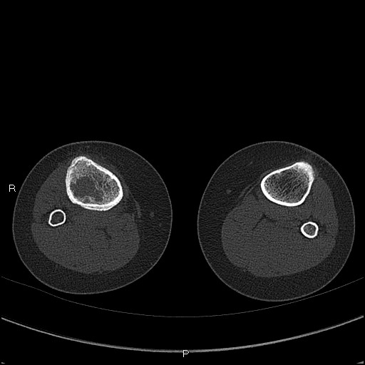 Chondroblastoma (Radiopaedia 62721-71030 Axial bone window 93).jpg