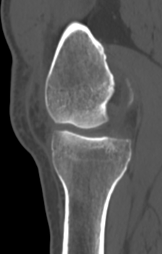 Chondrocalcinosis (Radiopaedia 82862-97173 Sagittal bone window 23).jpg
