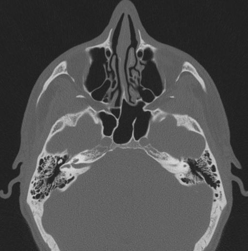 Chondrosarcoma (clivus) (Radiopaedia 46895-51425 Axial bone window 44).png