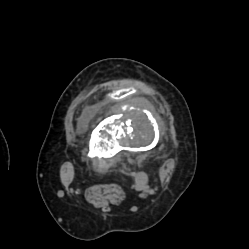 Chondrosarcoma - femur (Radiopaedia 64187-72954 Axial non-contrast 34).jpg