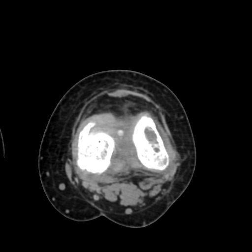 Chondrosarcoma - femur (Radiopaedia 64187-72954 Axial non-contrast 54).jpg