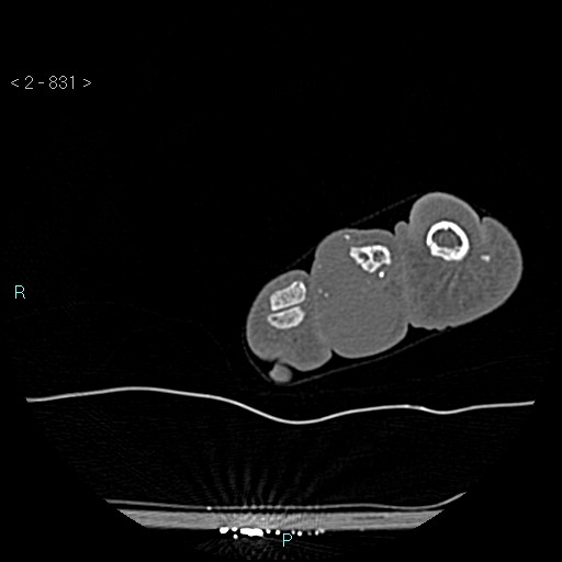 File:Chondrosarcoma - phalanx (Radiopaedia 69047-78812 Axial bone window 85).jpg