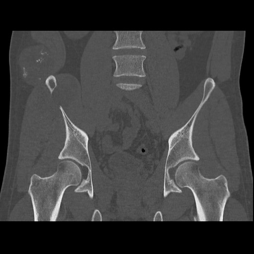Chondrosarcoma of iliac wing (Radiopaedia 63861-72599 Coronal bone window 61).jpg
