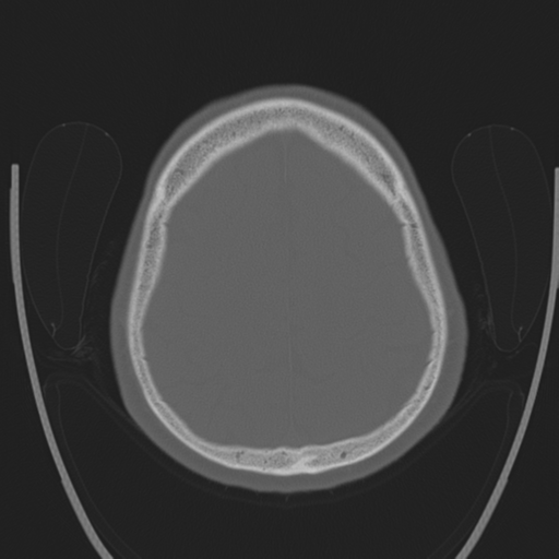 File:Chondrosarcoma of skull base- grade II (Radiopaedia 40948-43653 Axial bone window 39).png