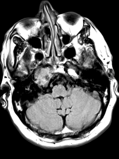 File:Chondrosarcoma of skull base- grade II (Radiopaedia 40948-43654 Axial T2 FLAIR 4).png