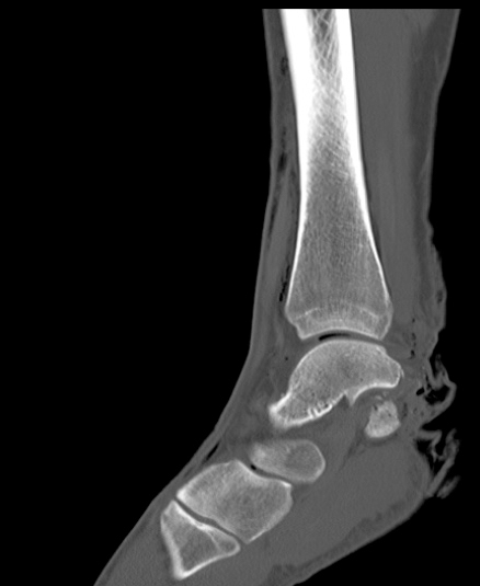 Chopart fracture (Radiopaedia 35347-36851 Sagittal bone window 26).jpg