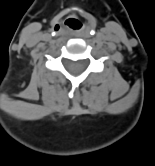 File:Chordoma (C4 vertebra) (Radiopaedia 47561-52188 Axial non-contrast 31).png