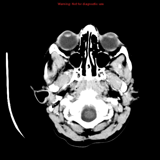 File:Choroid plexus carcinoma - recurrent (Radiopaedia 8330-9168 B 1).jpg