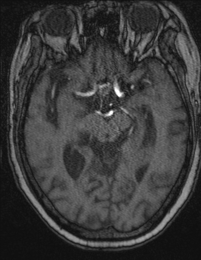 Choroid plexus xanthogranuloma - unilateral (Radiopaedia 85632-101393 Axial TOF 25).jpg