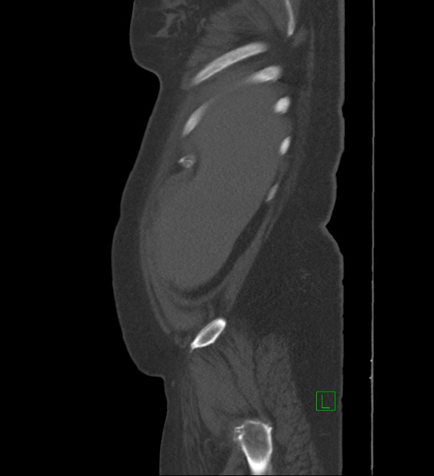 Chromophobe renal cell carcinoma (Radiopaedia 84239-99519 Sagittal bone window 97).jpg