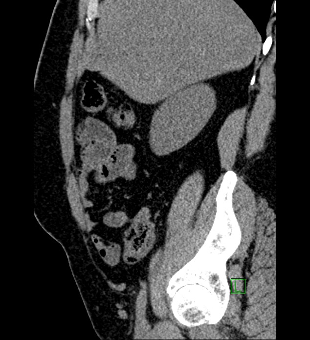 Chromophobe renal cell carcinoma (Radiopaedia 84286-99573 C 138).jpg