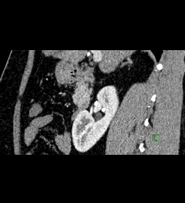 Chromophobe renal cell carcinoma (Radiopaedia 84286-99573 F 106).jpg
